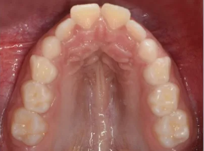 Antes: apiñamiento dental visto desde arriba, dientes desalineados