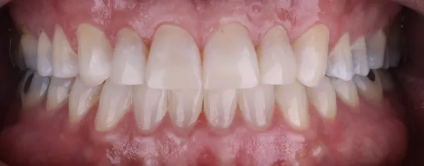 Después: sonrisa alineada tras tratamiento con alineadores