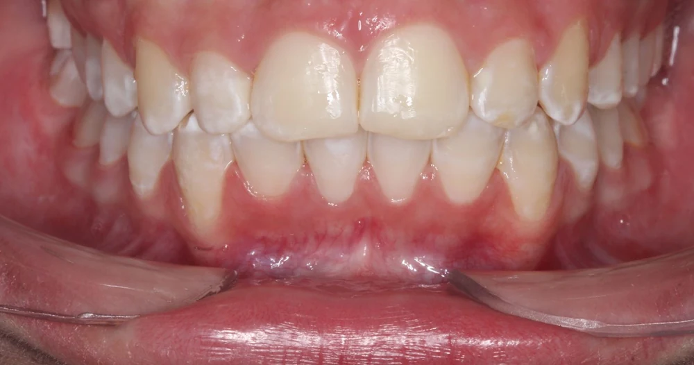 Después: los dientes alineados al terminar los brackets de autoligado