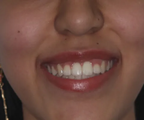 Después: la sonrisa alineada al terminar