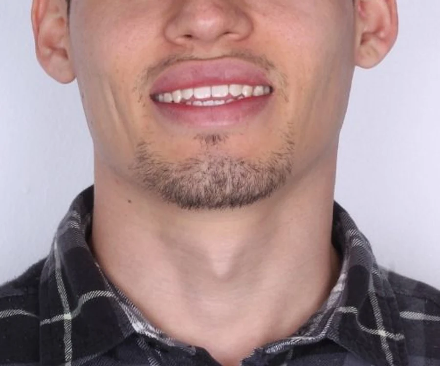 Antes: la sonrisa de frente, con los dientes de adelante desalineados