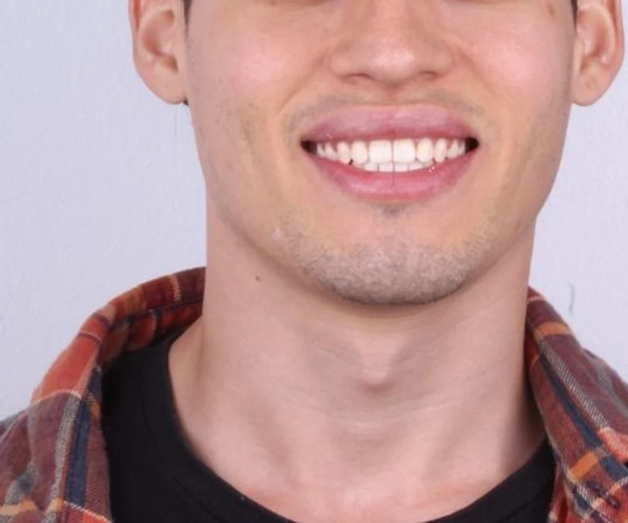 Después: la misma sonrisa de frente, con los dientes alineados al terminar los brackets